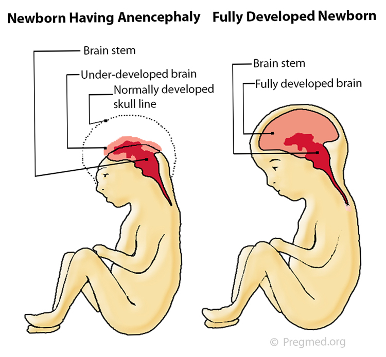 Anencephalic baby birth defects apologise, but Anencephalic baby birth defects that interrupt