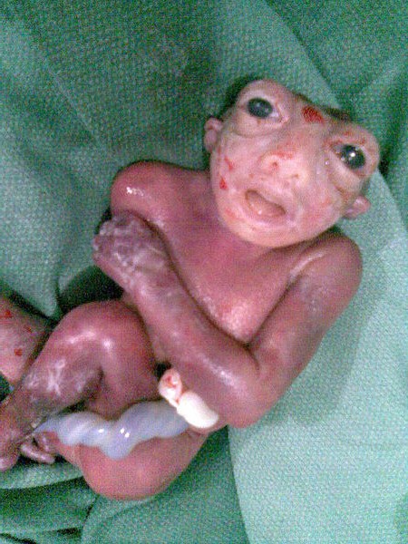 Anencephaly.jpg