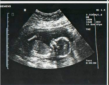 17 Weeks Pregnant - Body Changes, Symptoms, Ultrasound