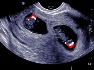 Creative and Fun Pregnancy Announcement Ideas