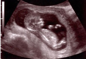 12 Weeks Pregnant Ultrasound Photo