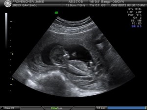 13 Week Pregnancy Ultrasound