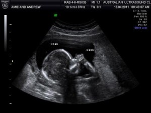 15 Weeks Pregnant Ultrasound Picture