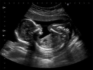18 Weeks Pregnant Ultrasound Picture