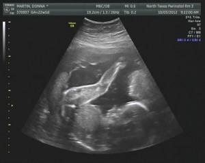 22 Weeks Pregnant Ultrasound Picture