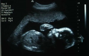 26 Weeks Pregnant Ultrasound Picture