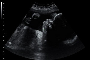 27 Weeks Pregnant Ultrasound Picture