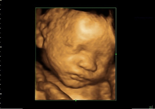 31 Weeks Pregnant Ultrasound Picture