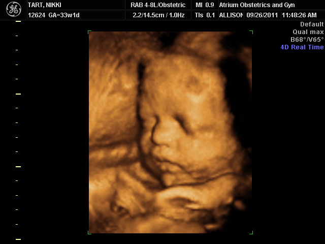 33 Weeks Pregnant Ultrasound Picture