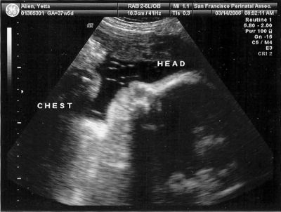 37 неделя коричневые. 37 Неделя беременности мальчик. УЗИ 37 недель беременности. Беременность 37 неделя картинка ребенка и органов.