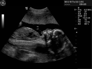 Anterior Placenta Ultrasound
