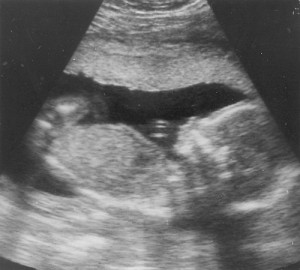 Oligohydramnios Ultrasound Picture