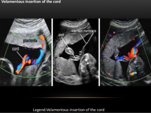 Velamentous Cord Insertion Ultrasound