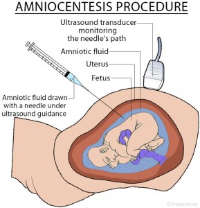 Amniocentesis Tests