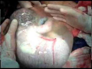 Baby Born in Amniotic Sac