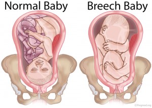 Breech Baby