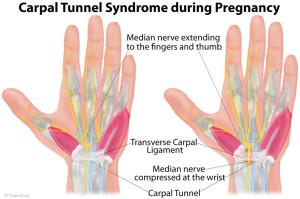 Carpal Tunnel Syndrome during Pregnancy