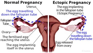 Ectopic Pregnancy vs Normal Pregnancy