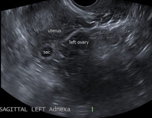 Ectopic Pregnancy Ultrasound Picture