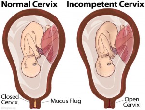 Incompetent Cervix