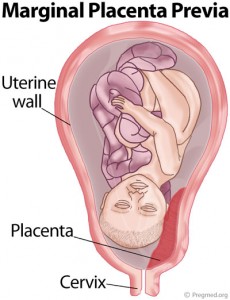 Marginal Placenta Previa