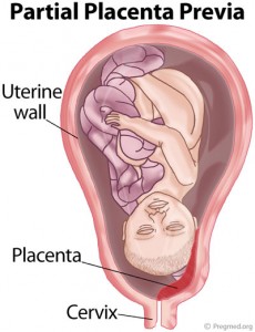 Partial Placenta Previa