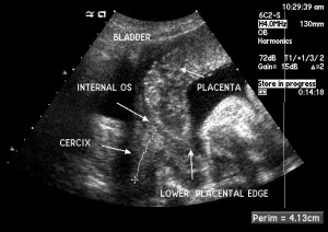 Placenta Previa Ultrasound