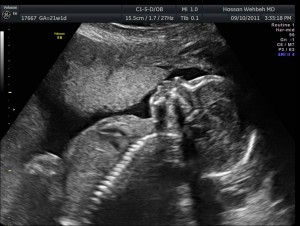 Second Trimester Ultrasound