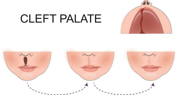 cleft lip and palatte